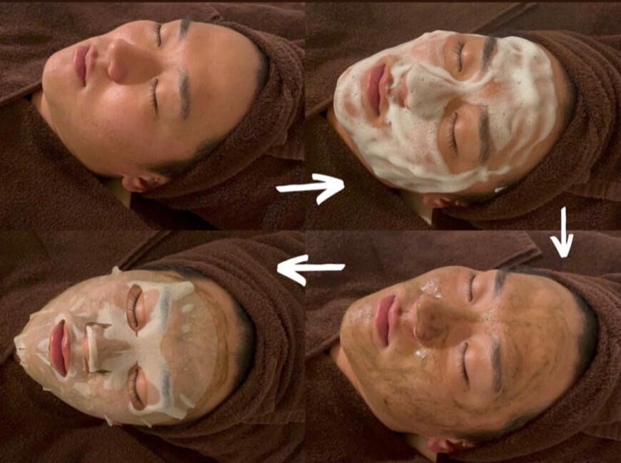 看護師による肌のお悩みカウンセリング】幹細胞ハーブピーリングで肌に