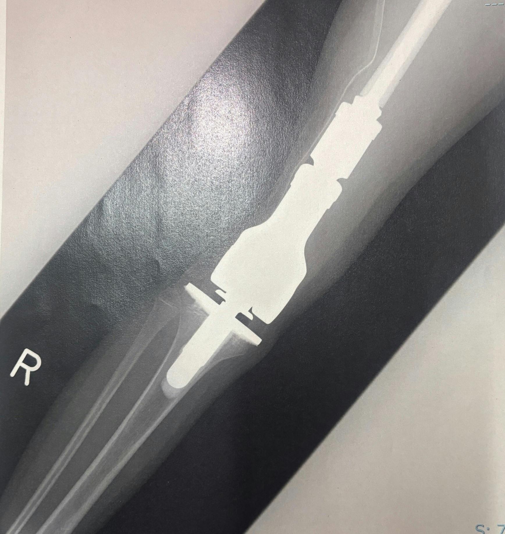 実際の手術後の人工関節のレントゲン