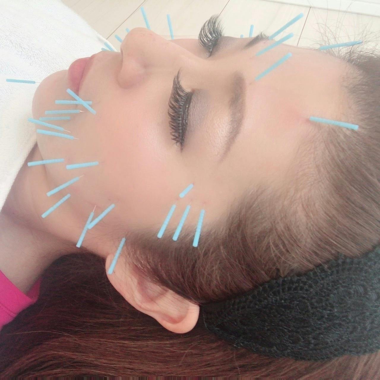 美容鍼とエレクトロポレーションの最強コンビで世の中の女性のキレイの